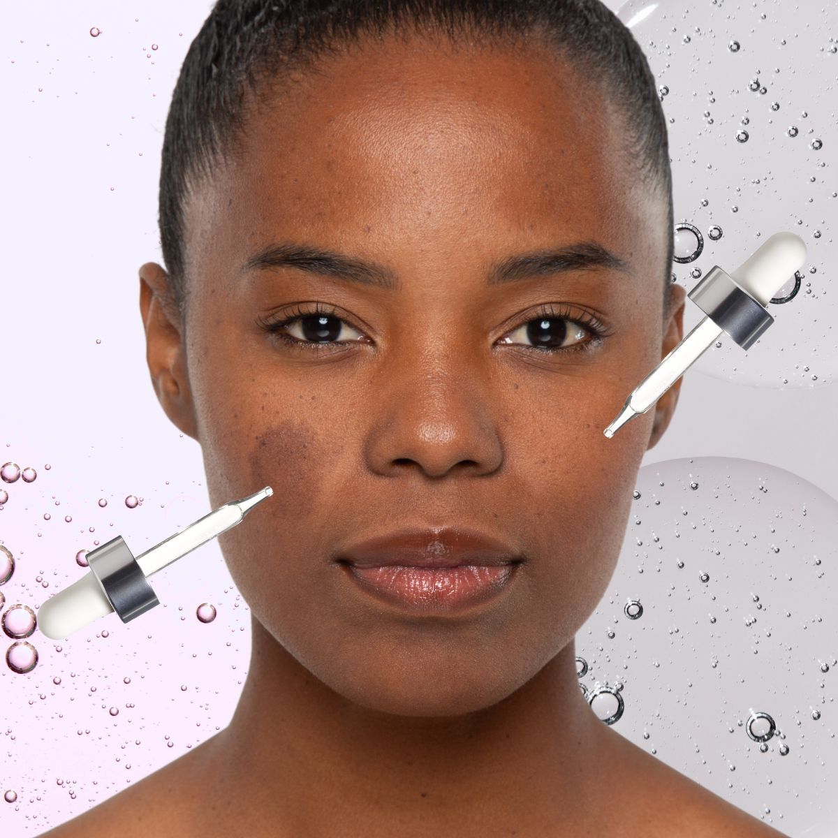 Featured image Azelaic Acid vs Niacinamide for Dark Spots